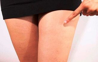 Les premiers signes et symptômes de varices