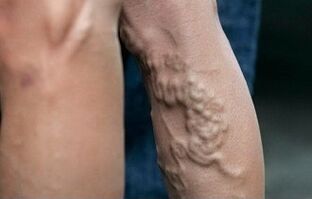Veines sur les jambes