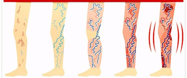 Ce qu'il ne faut pas faire en cas de varices