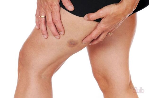 Si une veine se rompt