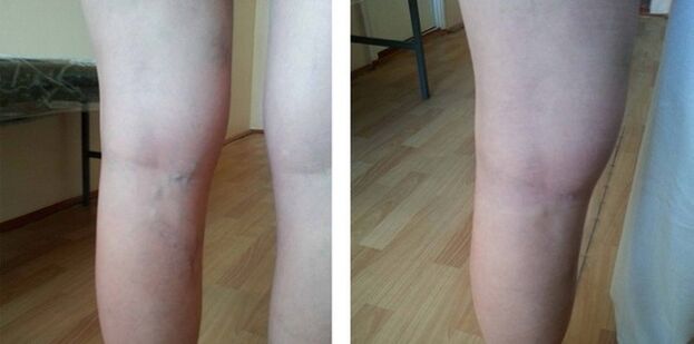 Varices dans les jambes