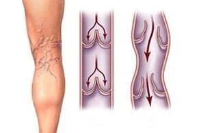 Écoulement de sang des varices à différents stades de développement de la maladie